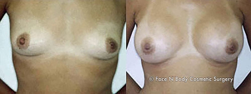 Breast Augmentation Before & After
