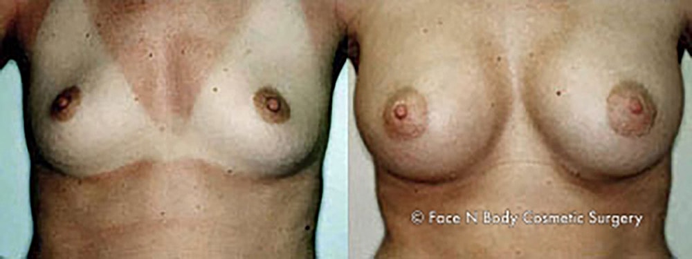 Breast Augmentation Before & After