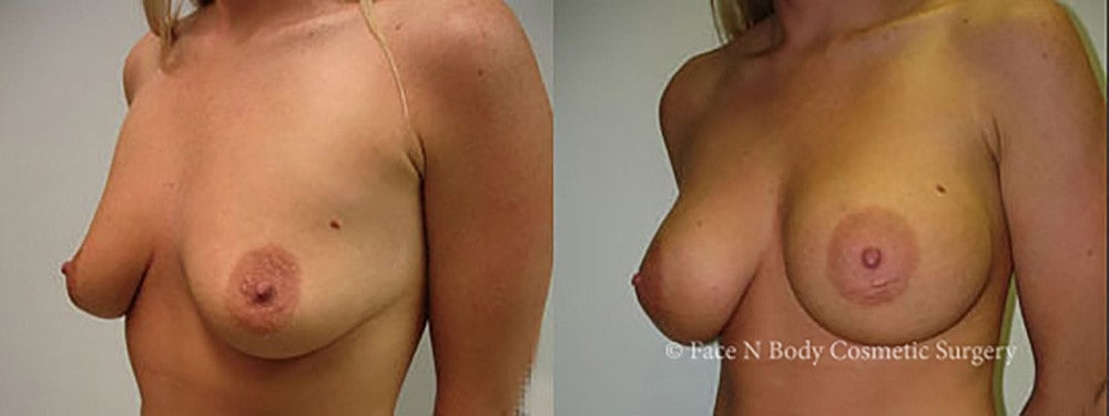 Breast Augmentation Before & After