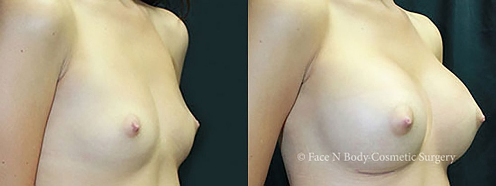 Breast Augmentation Before & After