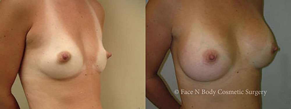 Breast Augmentation Before & After