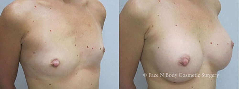 Breast Augmentation Before & After