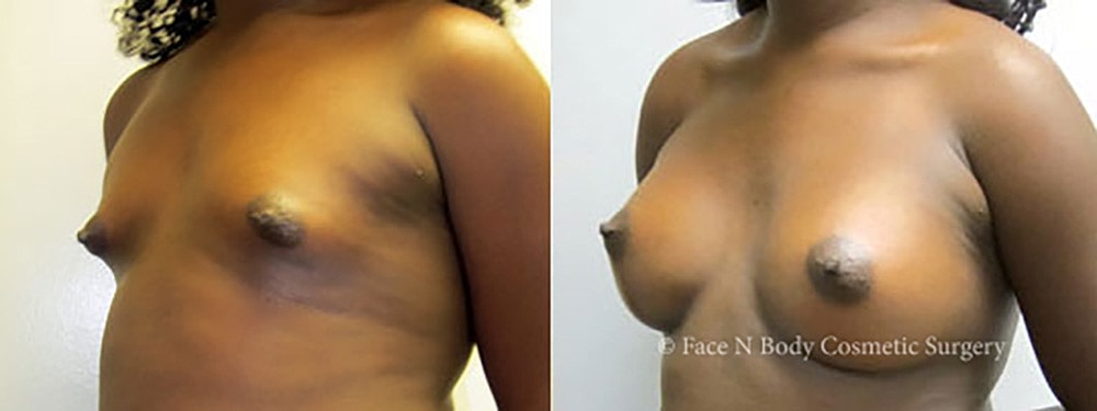 Breast Augmentation Before & After