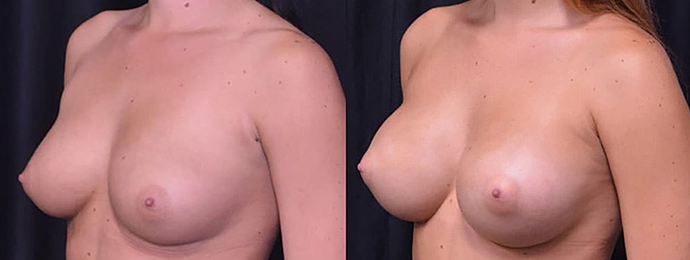 Breast Augmentation Before & After
