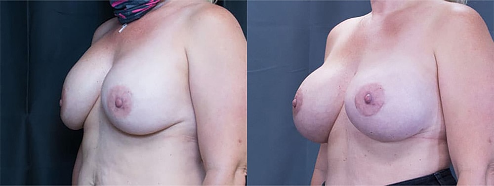 Breast Augmentation Before & After