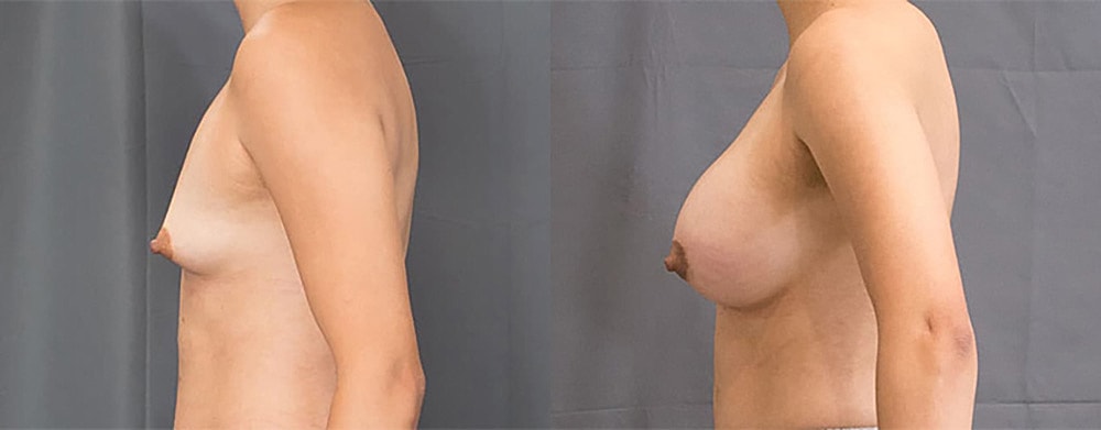 Breast Augmentation Before & After