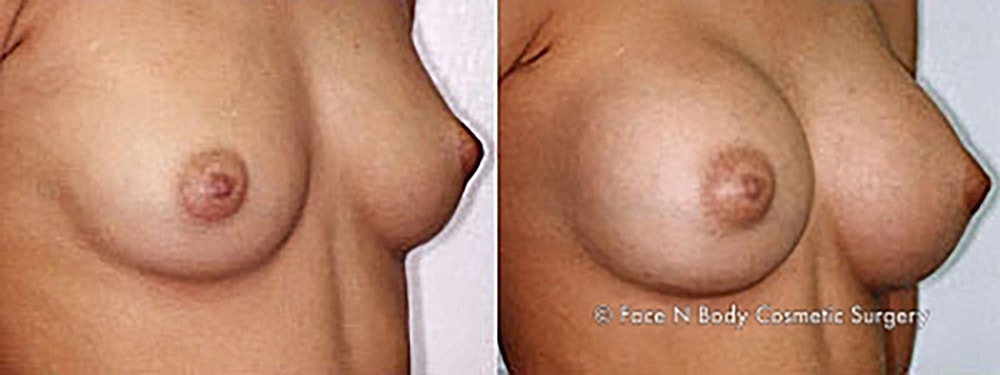 Breast Augmentation Before & After