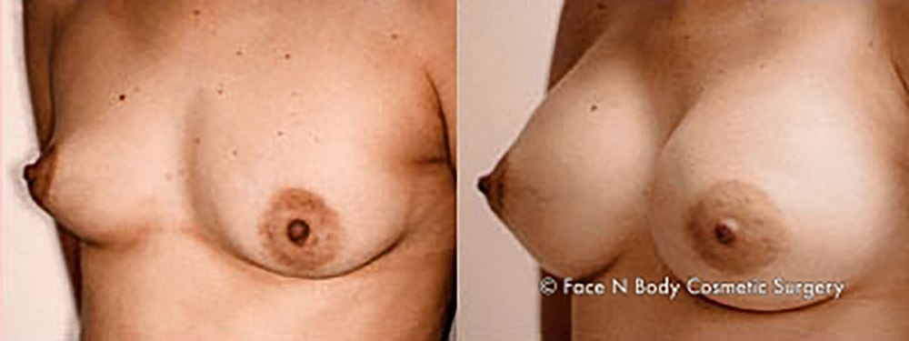Breast Augmentation Before & After
