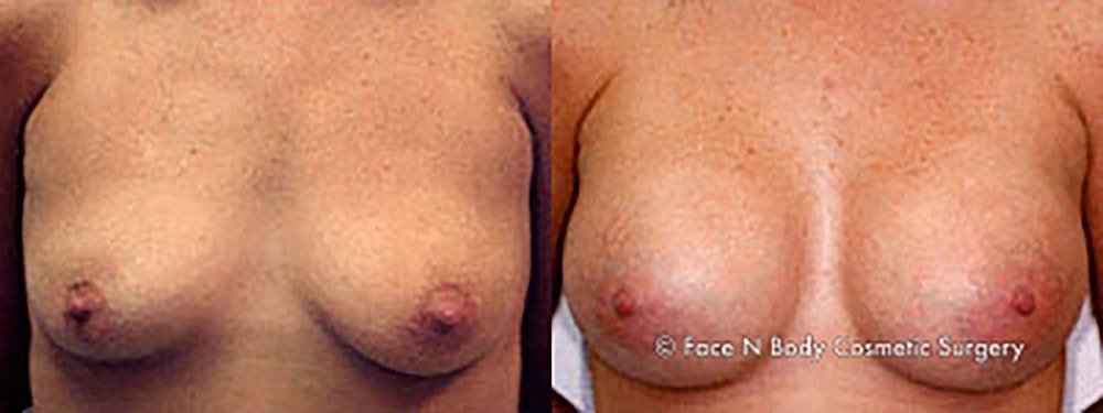 Breast Augmentation Before & After