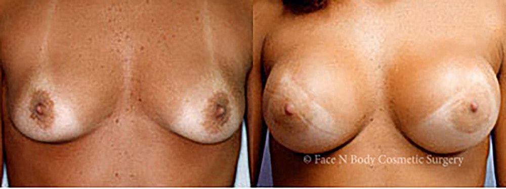 Breast Augmentation Before & After