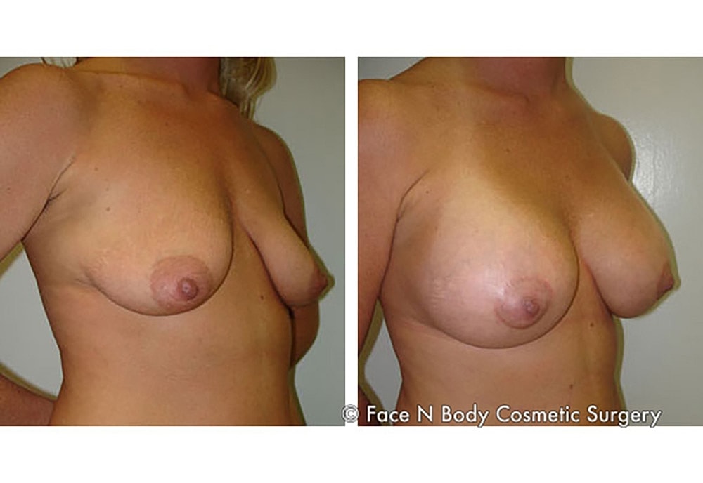 Breast Lift Before & After