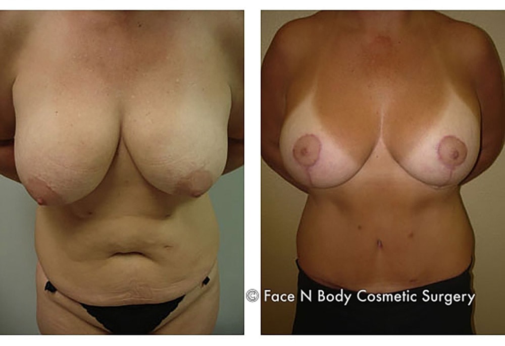 Breast Lift Before & After