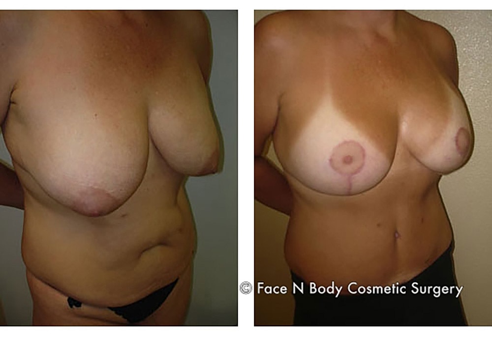 Breast Lift Before & After
