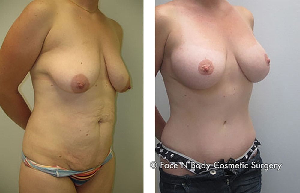 Breast Lift Before & After
