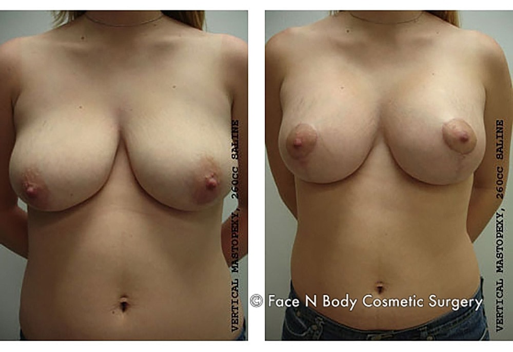 Breast Lift Before & After