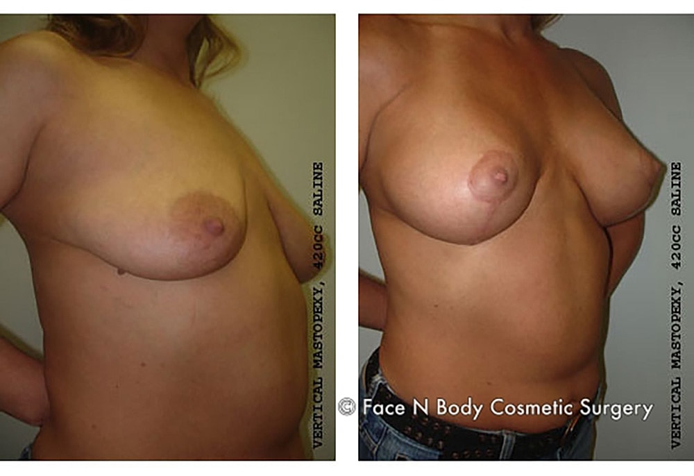Breast Lift Before & After