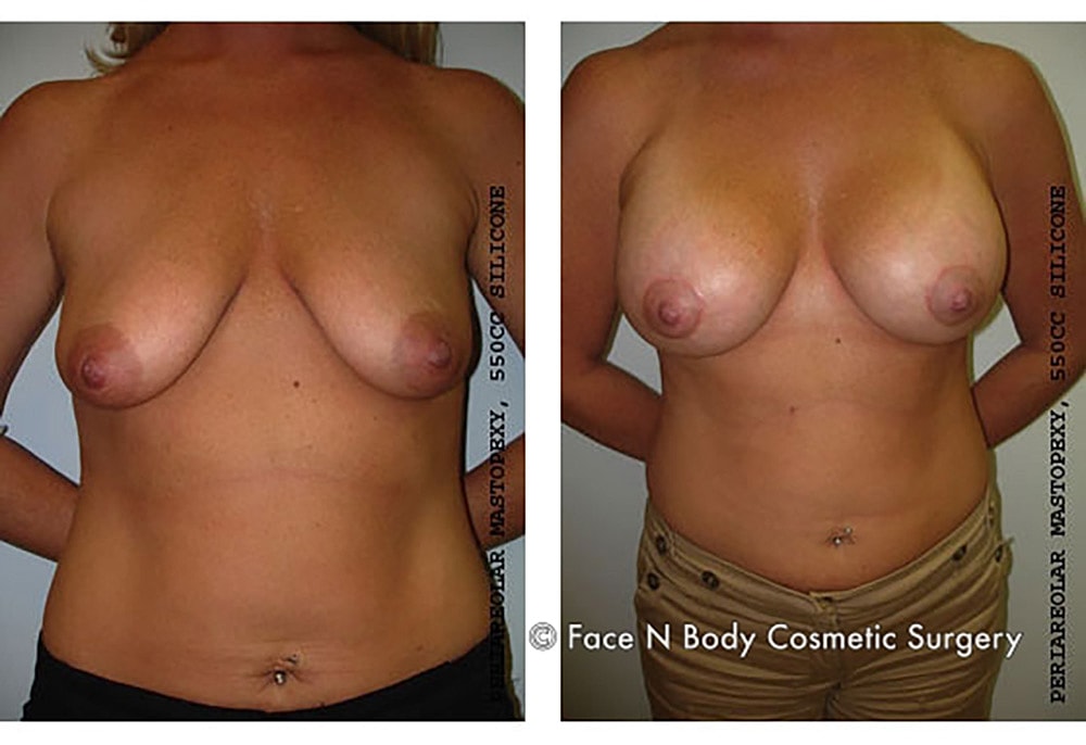 Breast Lift Before & After