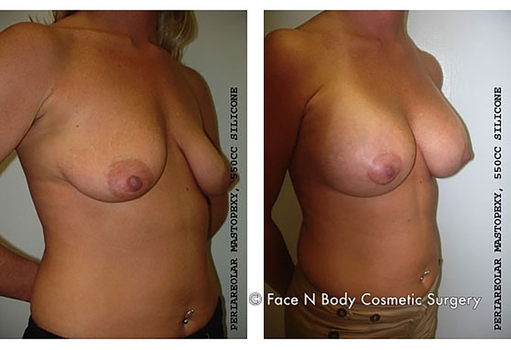 Breast Lift Before & After