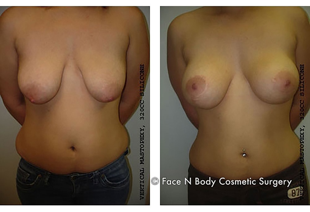 Breast Lift Before & After