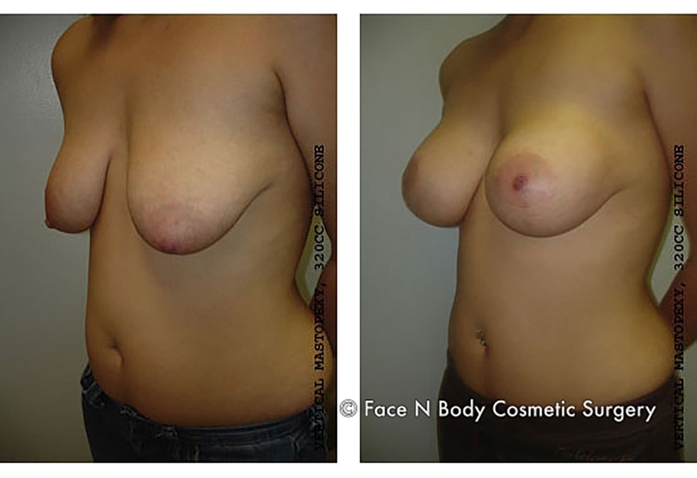 Breast Lift Before & After