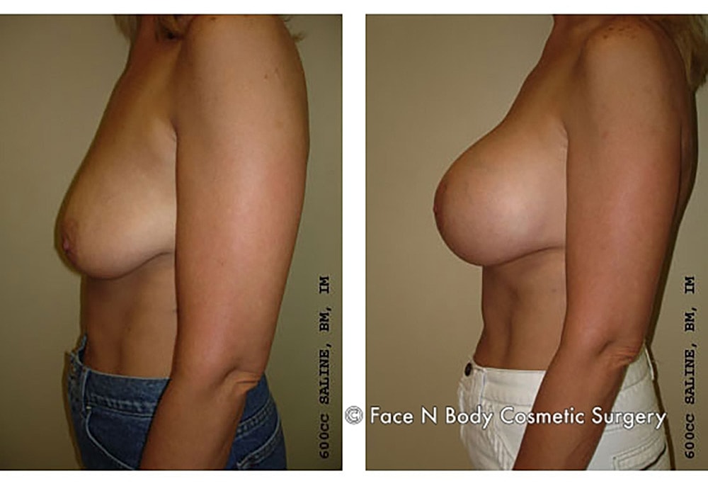 Breast Lift Before & After