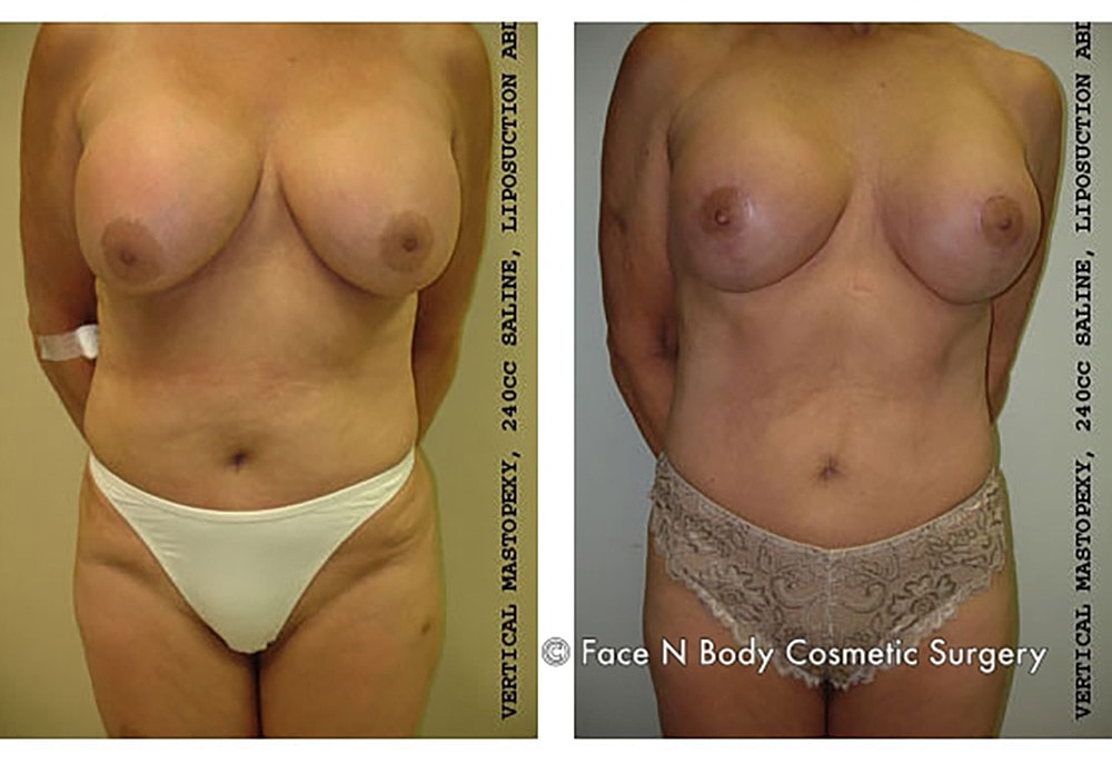 Breast Lift Before & After
