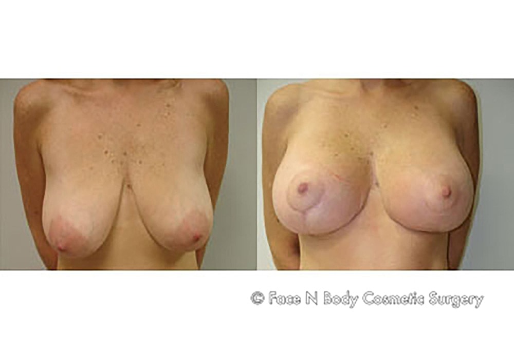 Breast Lift Before & After