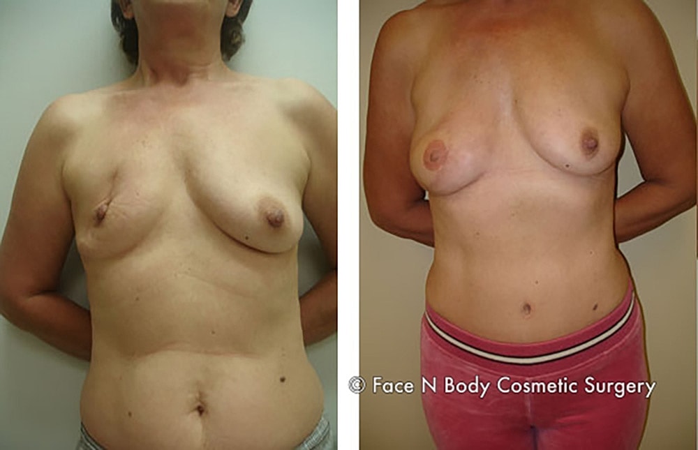 Breast Cancer Reconstruction Before & After