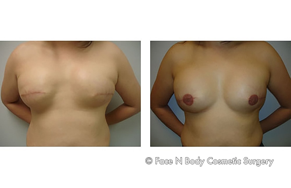 Breast Cancer Reconstruction Before & After