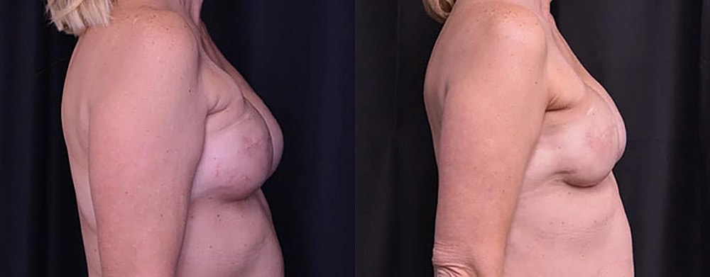Breast Cancer Reconstruction Before & After