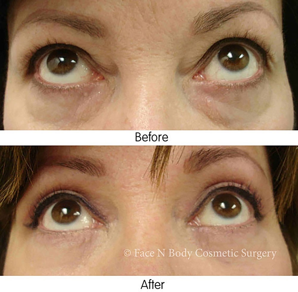 Eyelid Lift Procedure Before & After