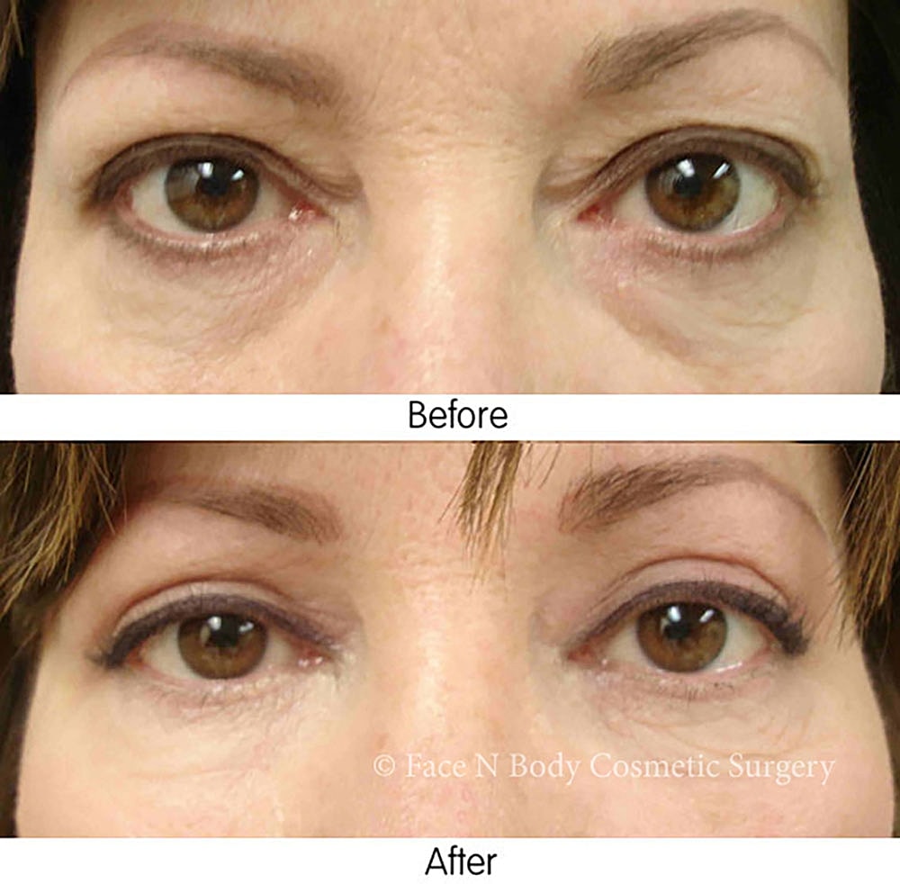 Eyelid Lift Procedure Before & After