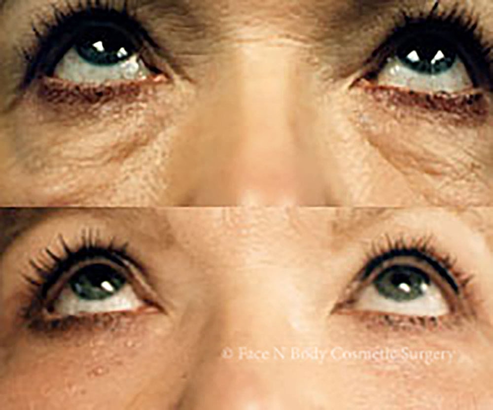 Eyelid Lift Procedure Before & After