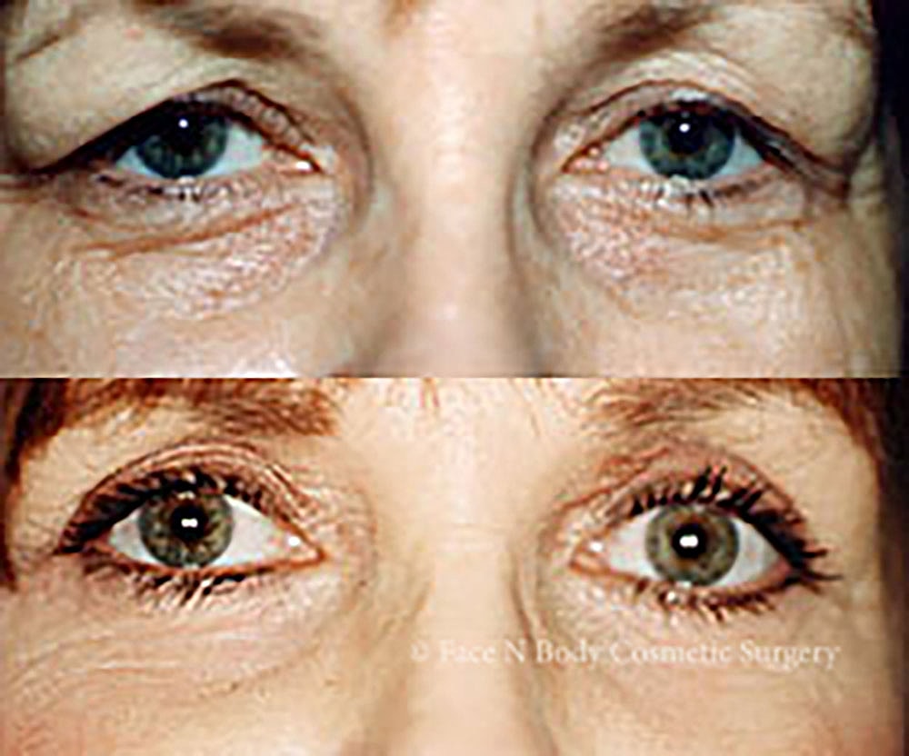 Eyelid Lift Procedure Before & After