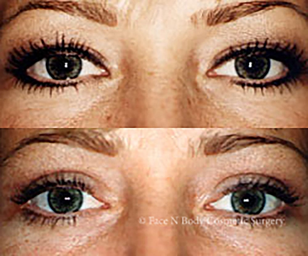 Eyelid Lift Procedure Before & After