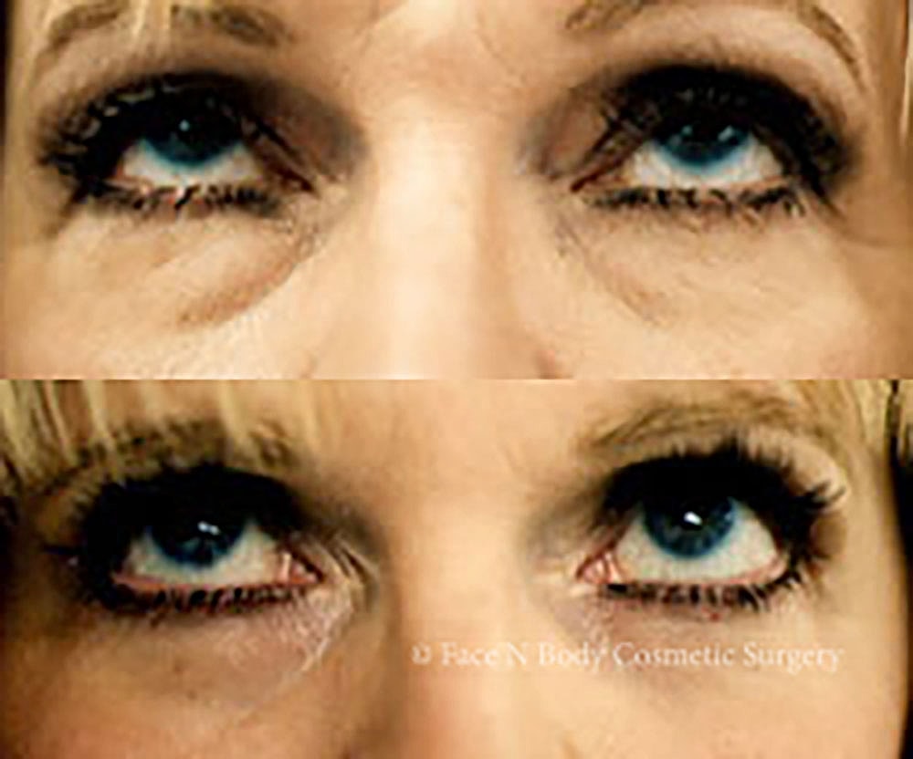 Eyelid Lift Procedure Before & After