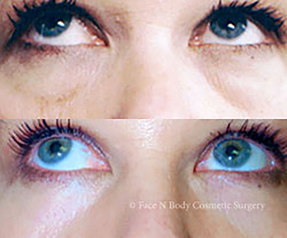 Eyelid Lift Procedure Before & After