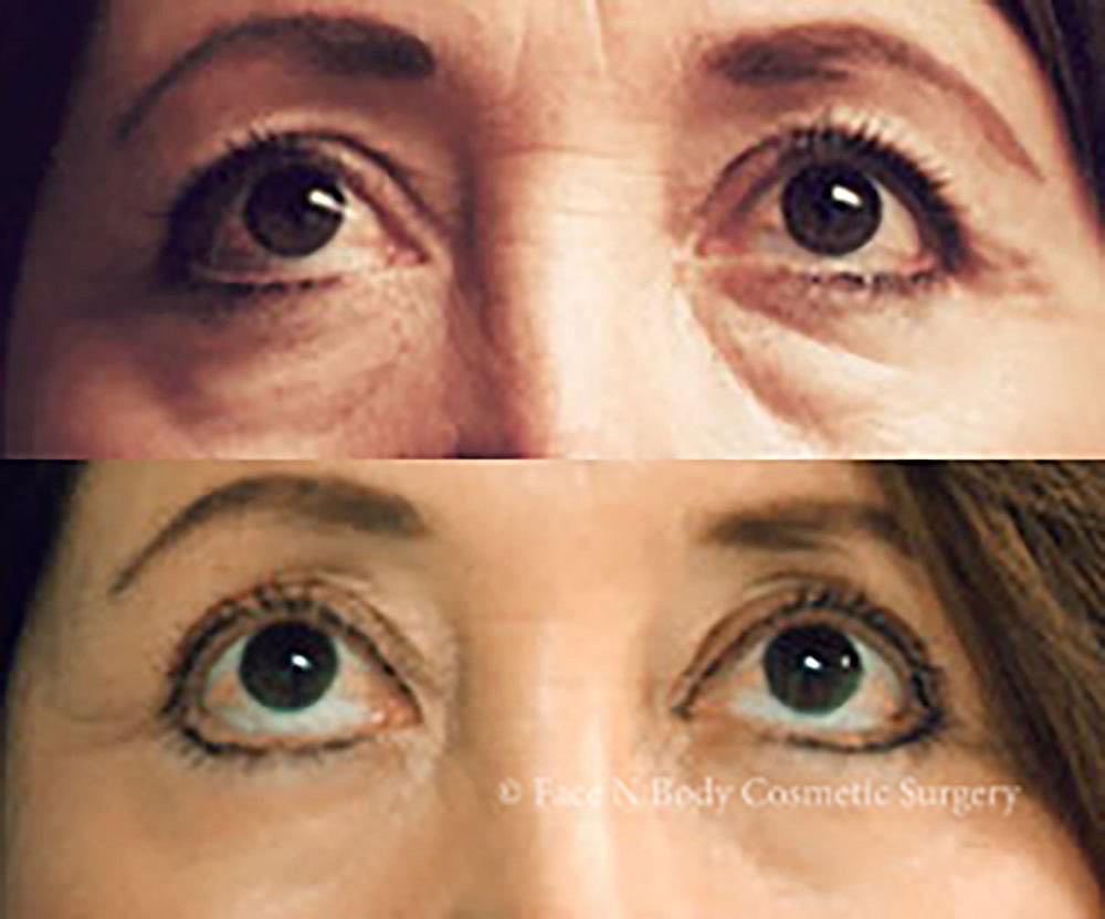Eyelid Lift Procedure Before & After