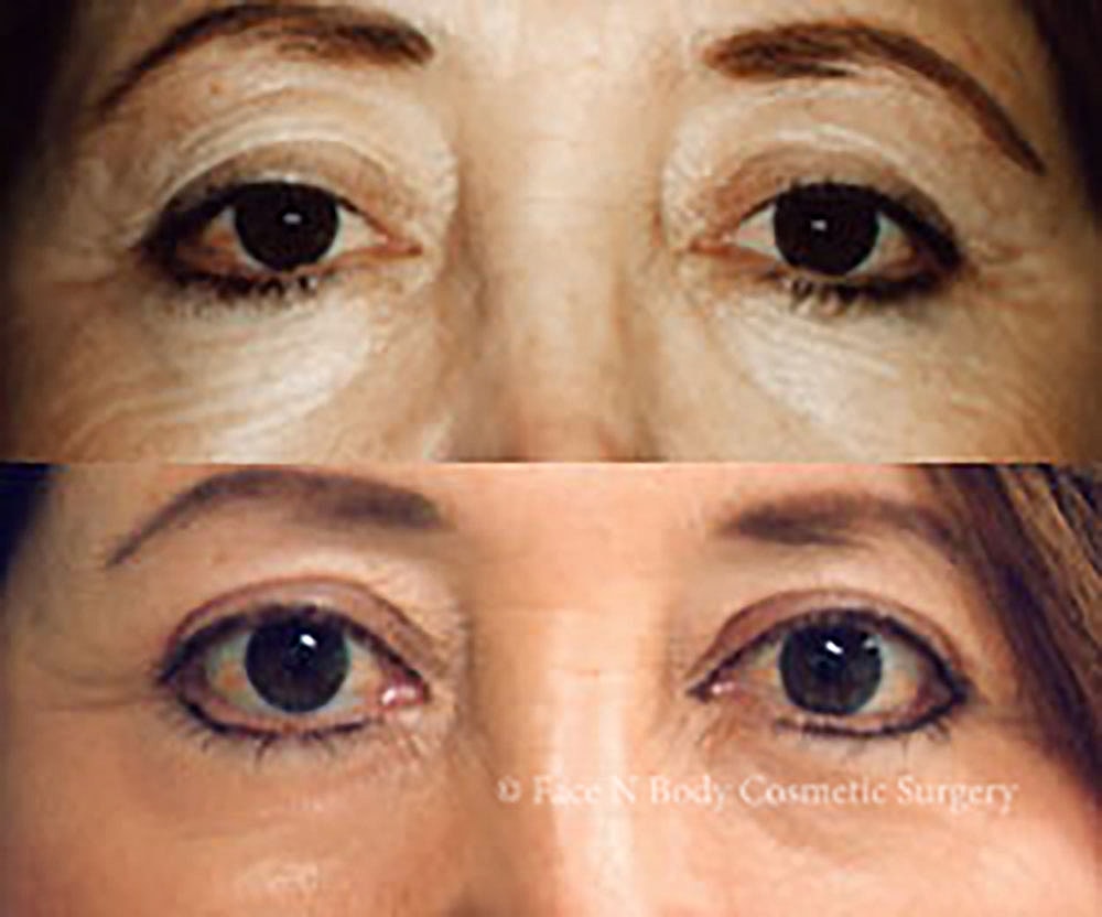 Eyelid Lift Procedure Before & After