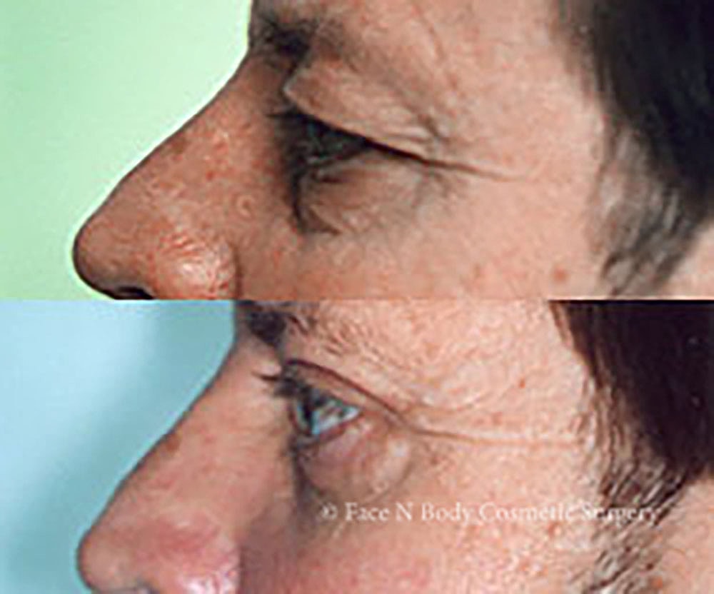 Eyelid Lift Procedure Before & After