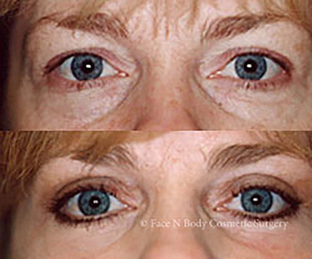 Eyelid Lift Procedure Before & After