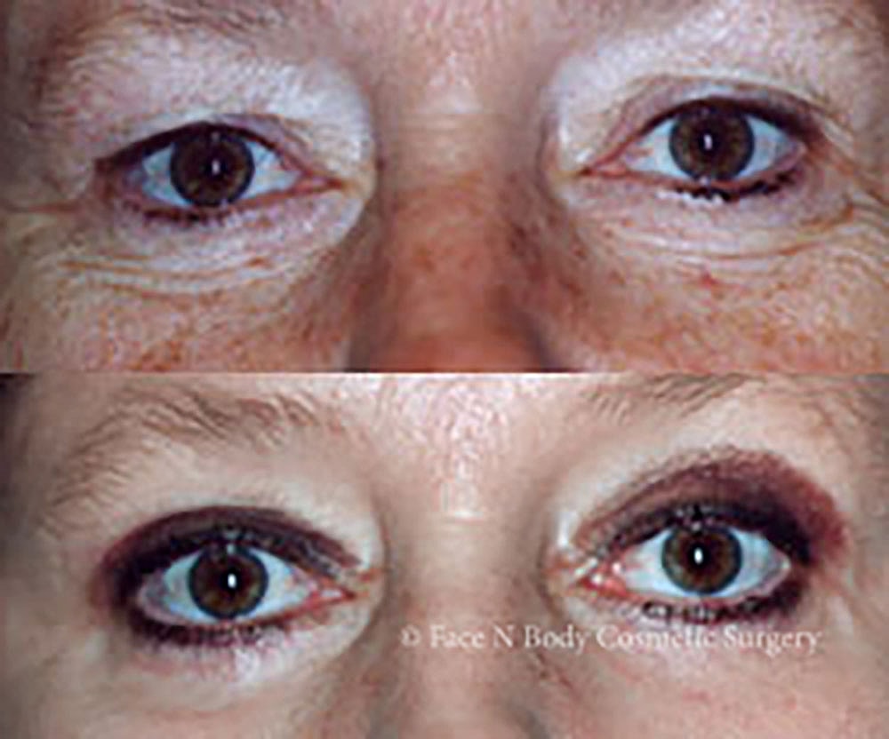 Eyelid Lift Procedure Before & After