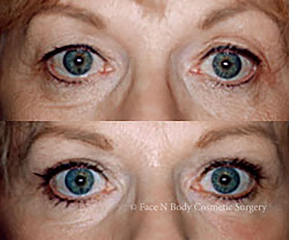 Eyelid Lift Procedure Before & After