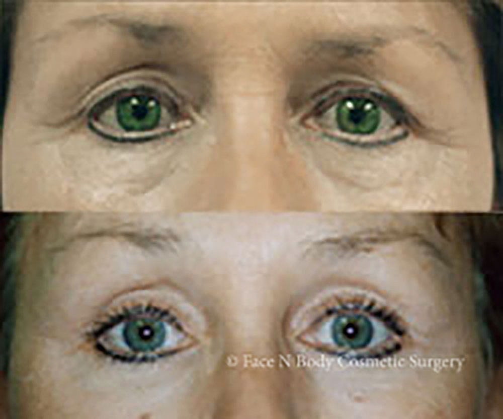 Eyelid Lift Procedure Before & After