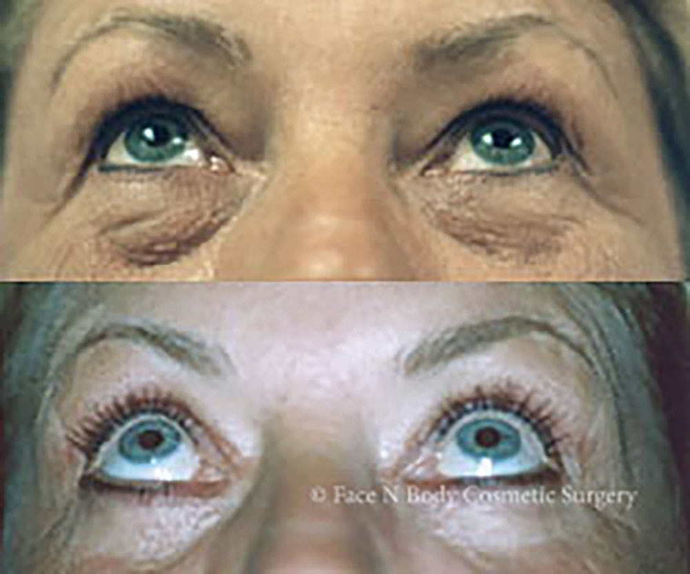 Eyelid Lift Procedure Before & After