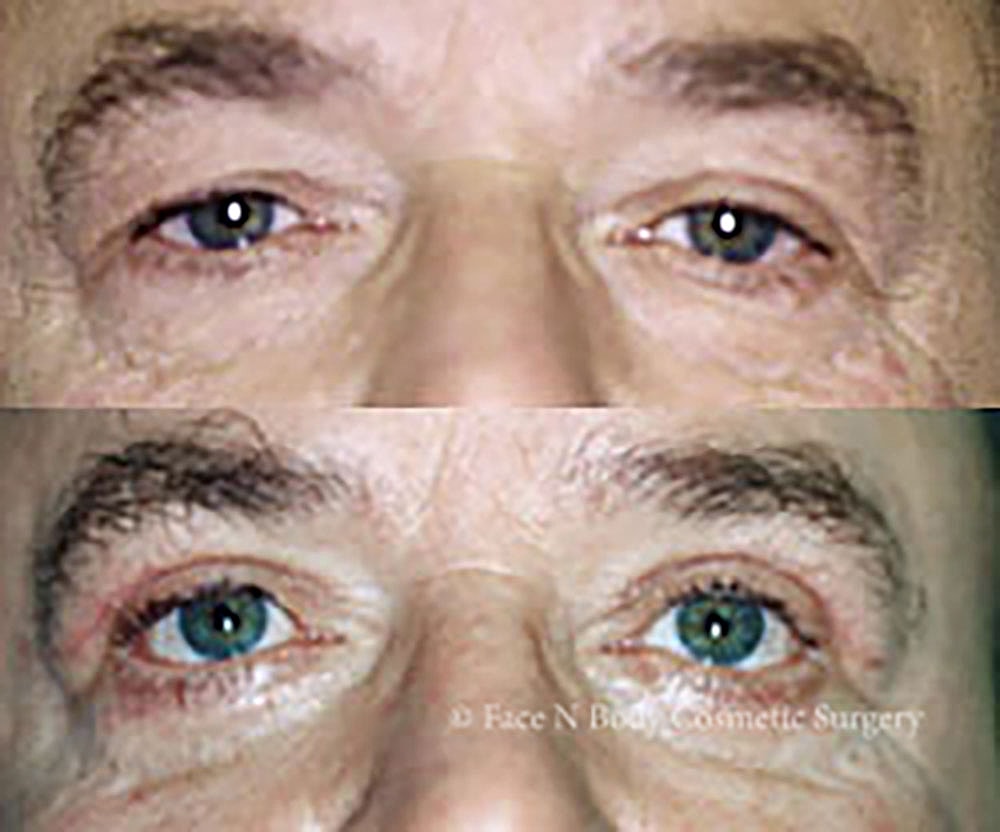 Eyelid Lift Procedure Before & After