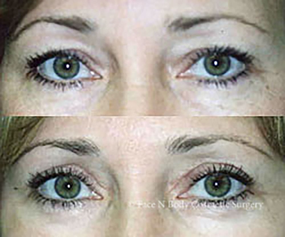 Eyelid Lift Procedure Before & After