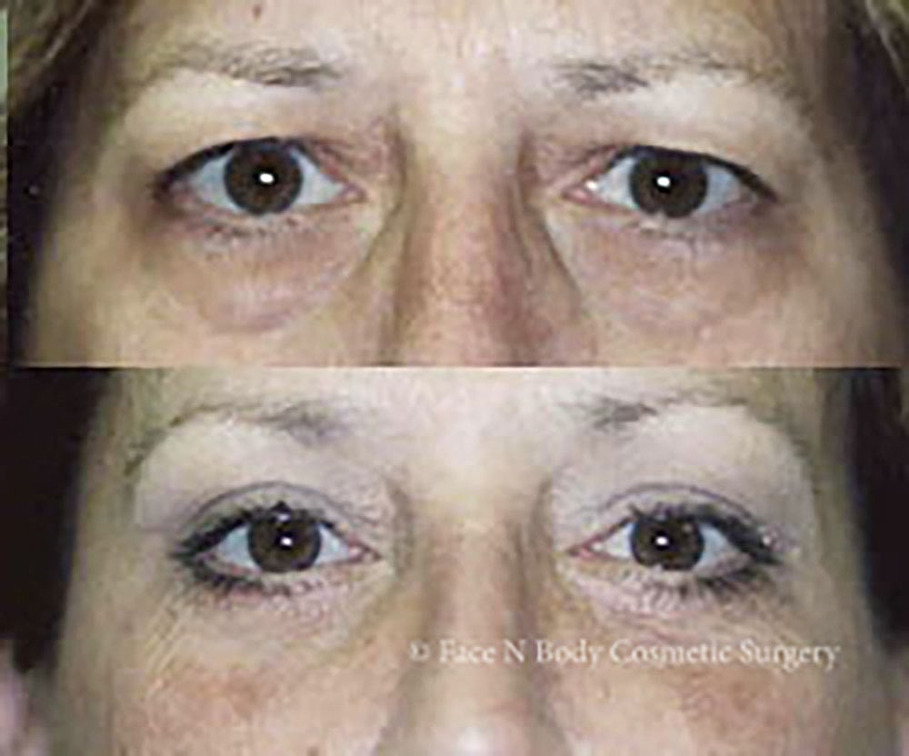 Eyelid Lift Procedure Before & After