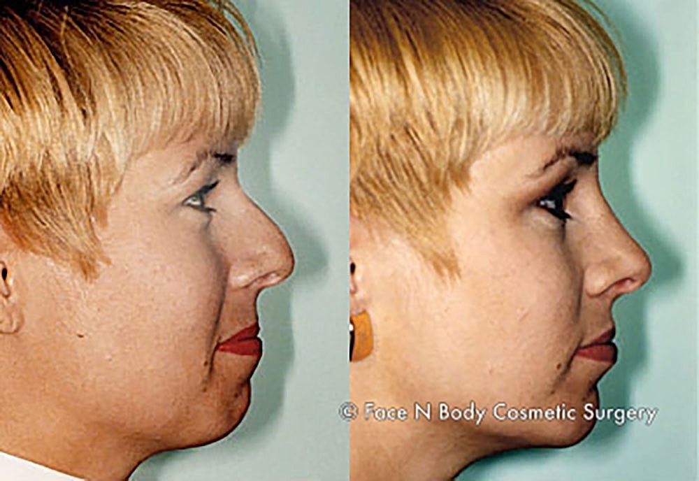 Chin Augmentation Before & After
