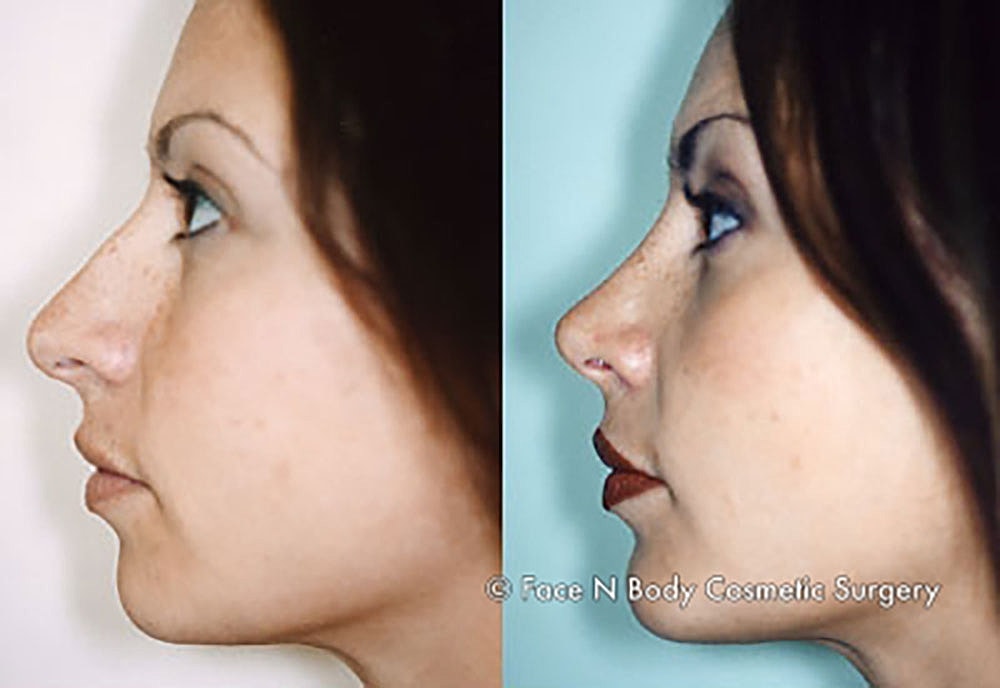 Chin Augmentation Before & After